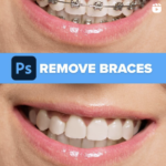 Remove Braces