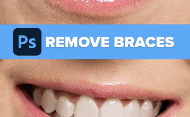 Remove Braces